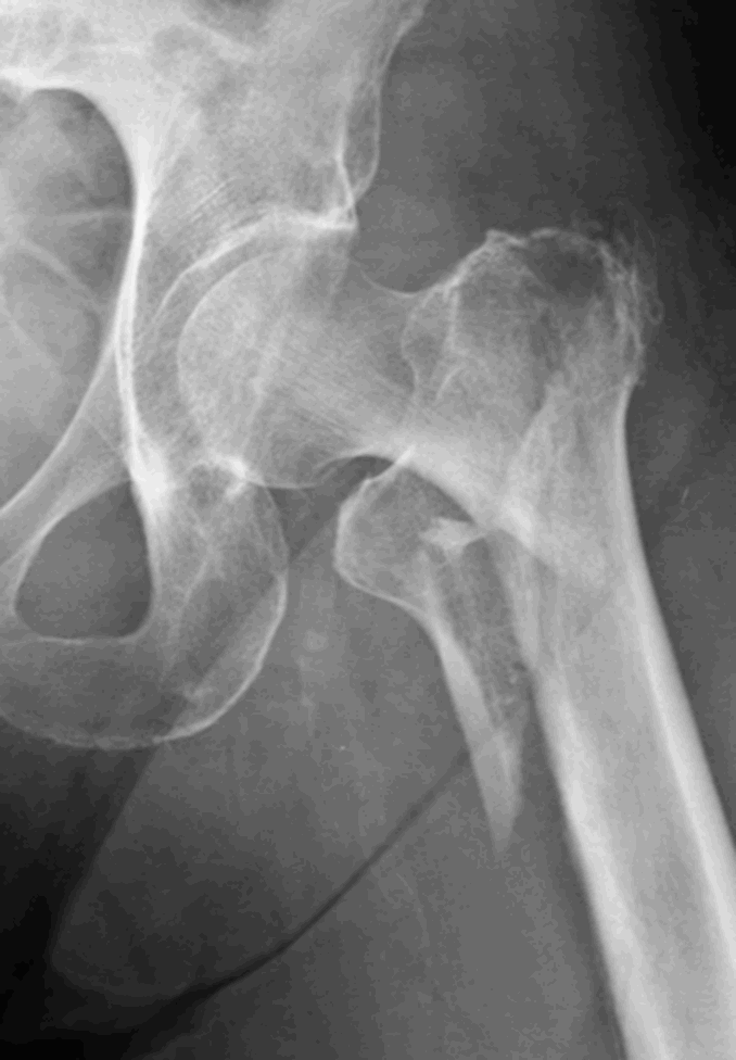 Radiograph of an intertrochanteric hip fracture