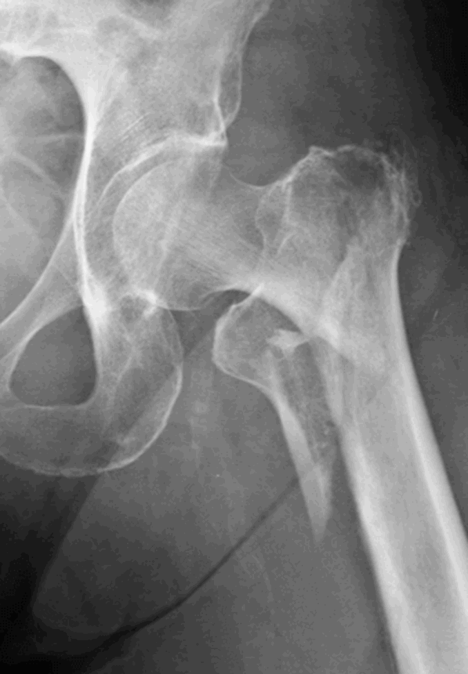 Radiograph of an intertrochanteric hip fracture